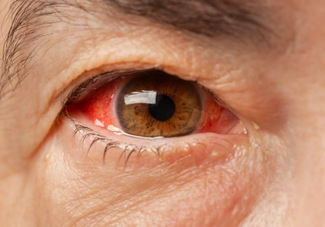 4-dangerous-pink-eye-symptoms